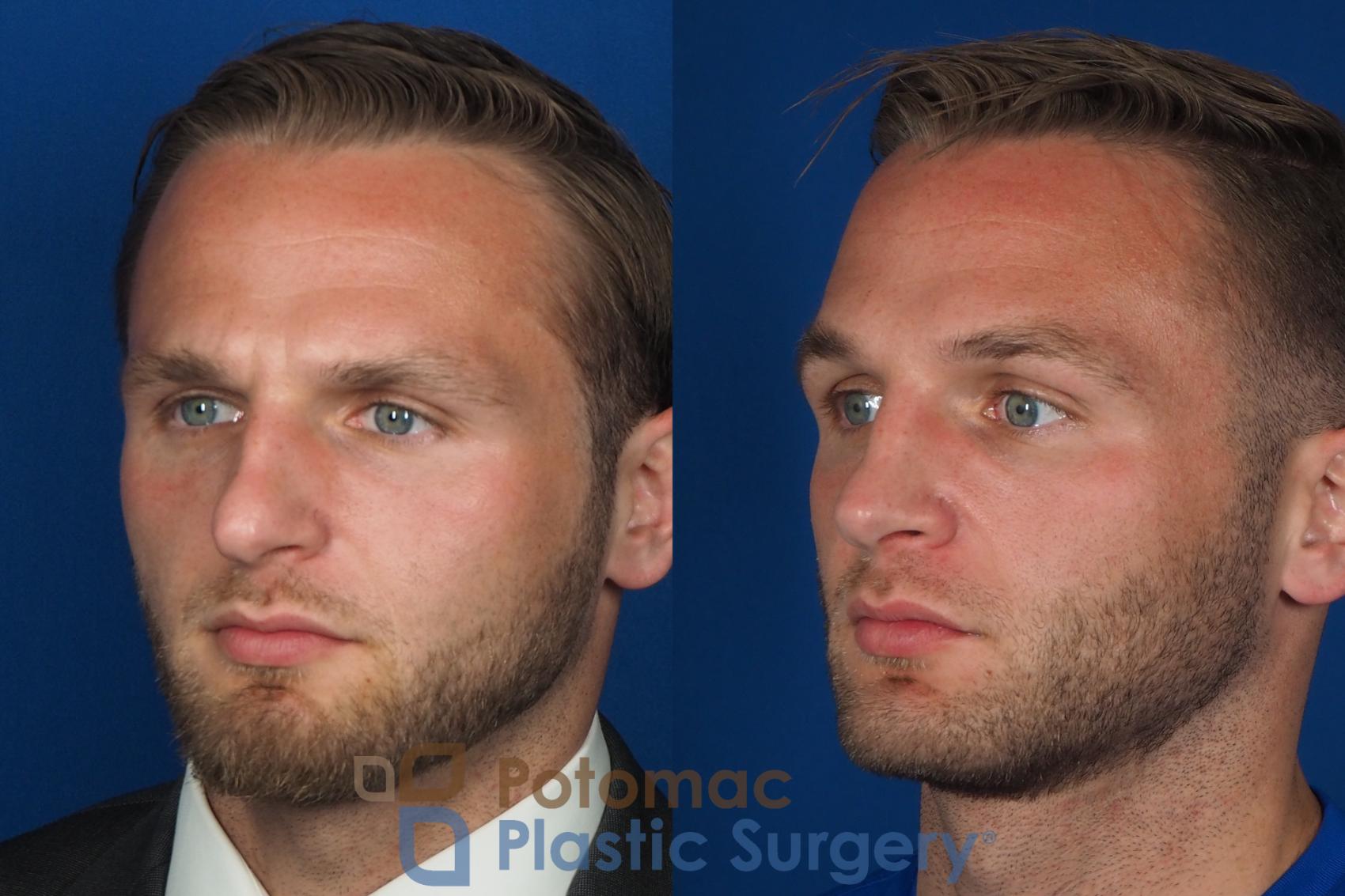 Before & After Rhinoplasty - Medical Case 335 Left Oblique View in Washington DC & Arlington , DC