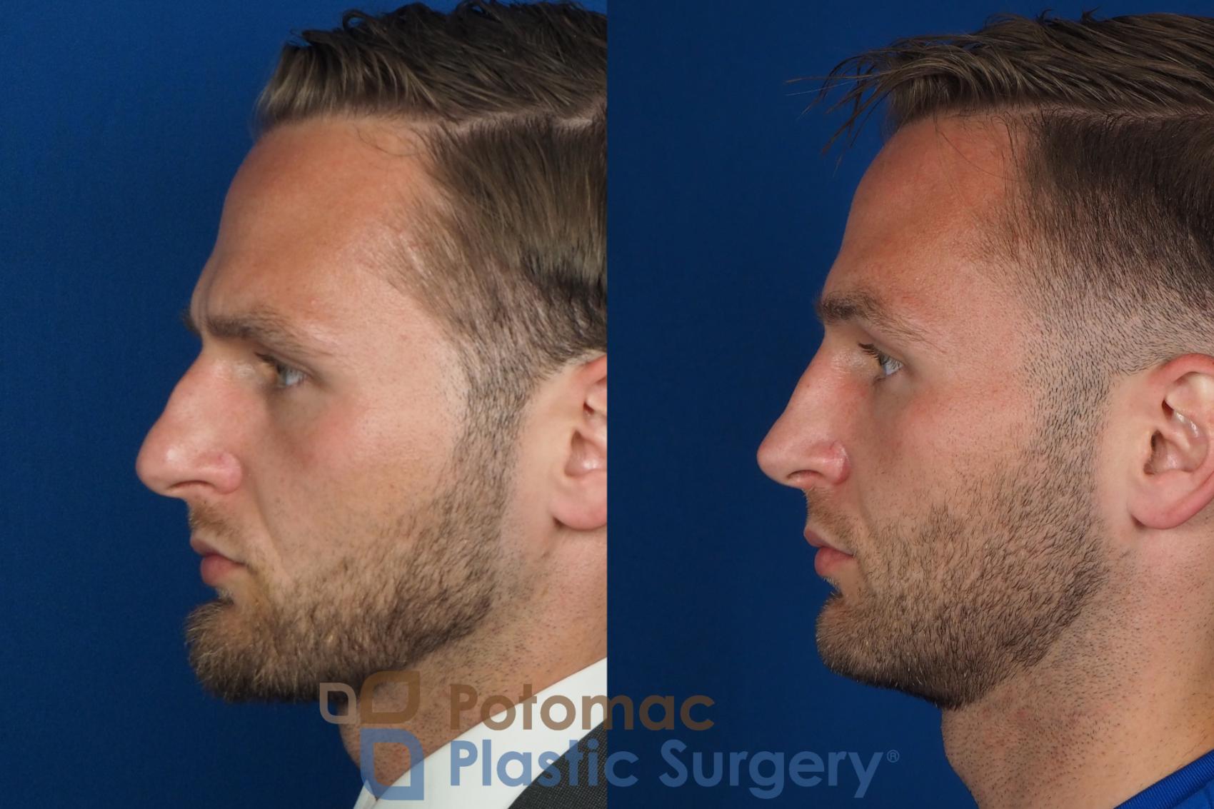 Before & After Rhinoplasty - Medical Case 335 Left Side View in Washington DC & Arlington , DC