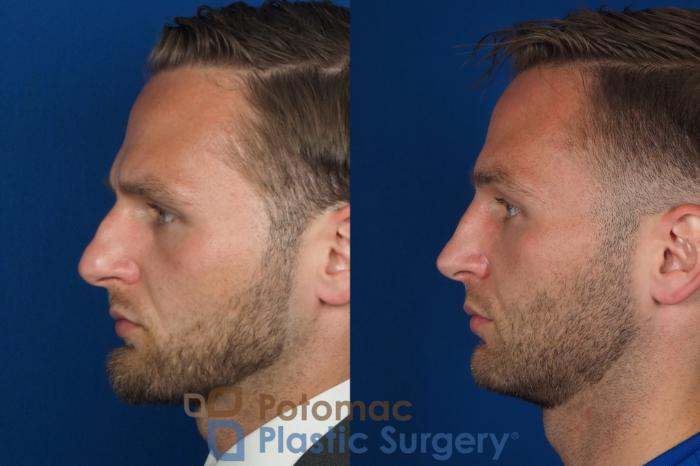 Before & After Rhinoplasty - Cosmetic Case 335 Left Side View in Washington DC & Arlington , DC