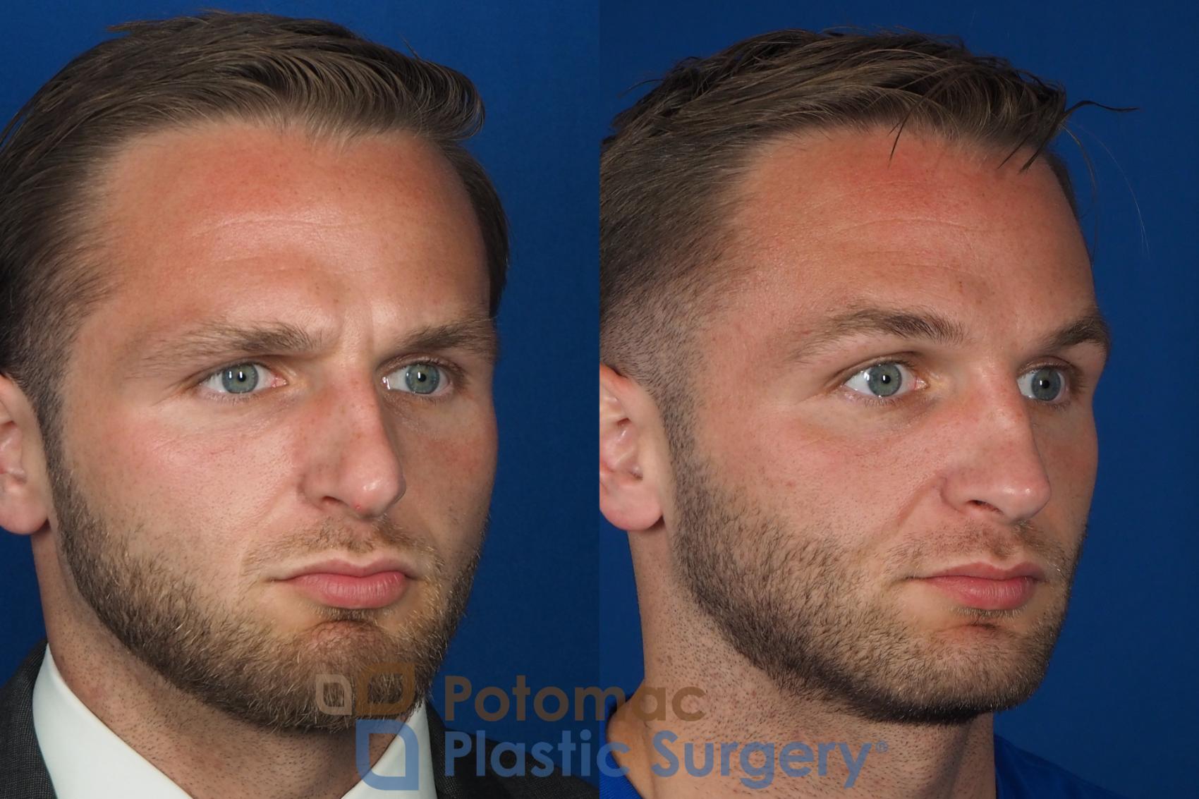 Before & After Rhinoplasty - Medical Case 335 Right Oblique View in Washington DC & Arlington , DC
