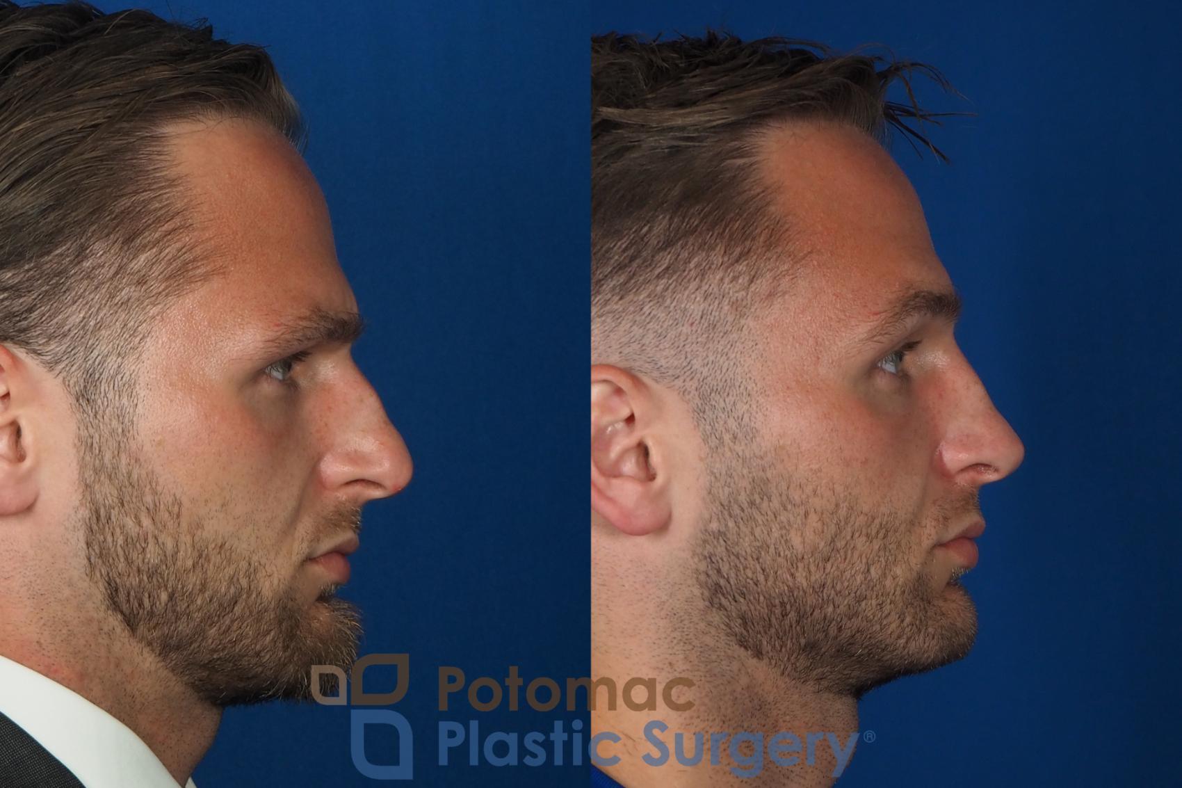 Before & After Rhinoplasty - Cosmetic Case 335 Right Side View in Washington DC & Arlington , DC