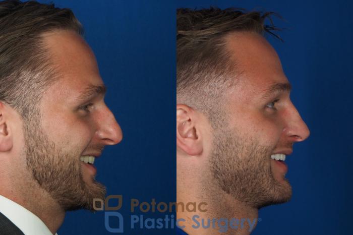 Before & After Rhinoplasty - Cosmetic Case 335 Right - Smiling View in Washington DC & Arlington , DC