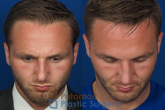 Before & After Rhinoplasty - Cosmetic Case 335 Top View in Washington DC & Arlington , DC