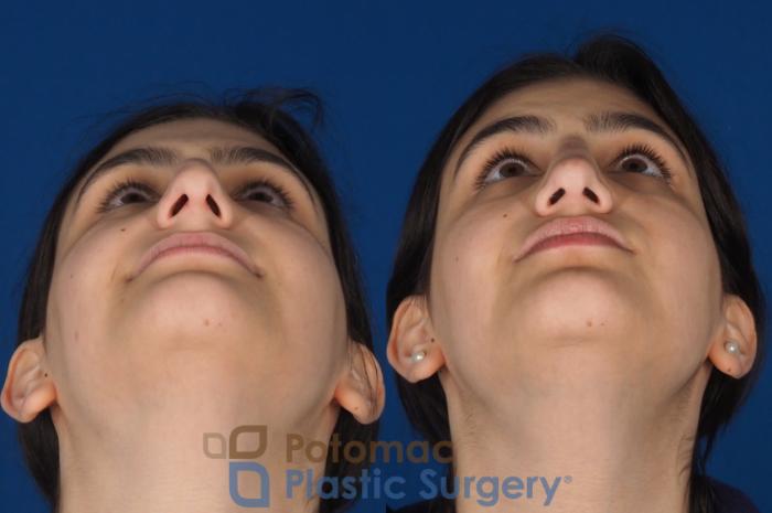 Before & After Rhinoplasty - Cosmetic Case 336 Bottom View in Washington DC & Arlington , DC