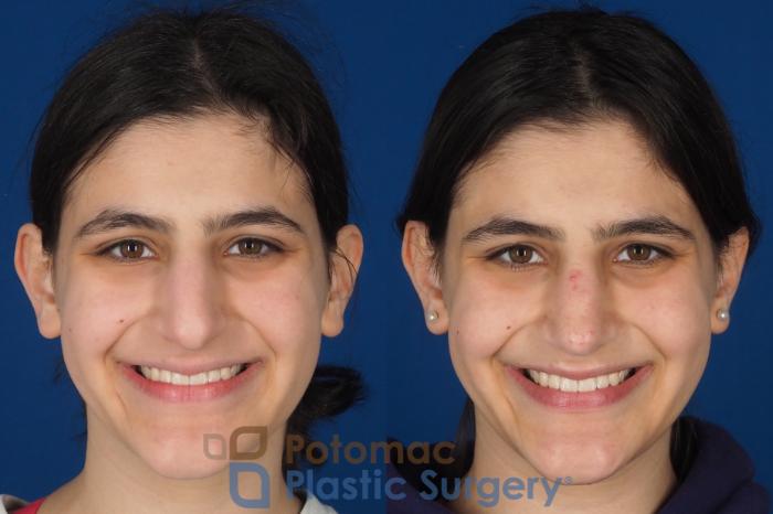 Before & After Rhinoplasty - Cosmetic Case 336 Front - Smiling View in Washington DC & Arlington , DC