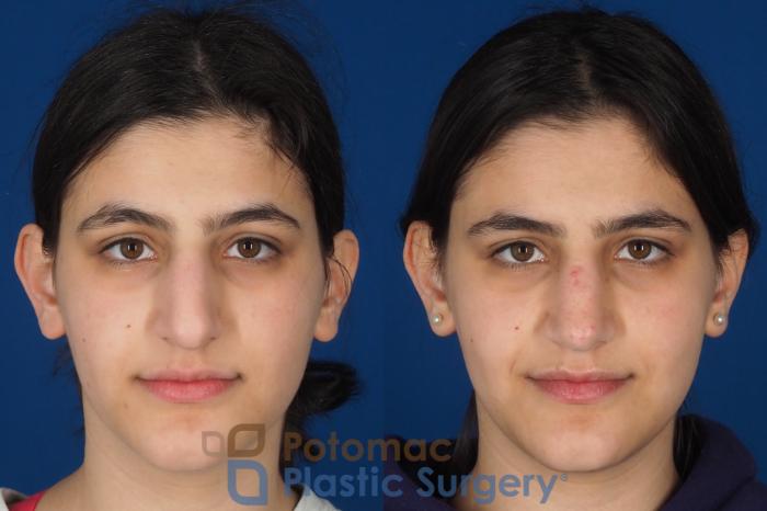 Before & After Rhinoplasty - Cosmetic Case 336 Front View in Washington DC & Arlington , DC