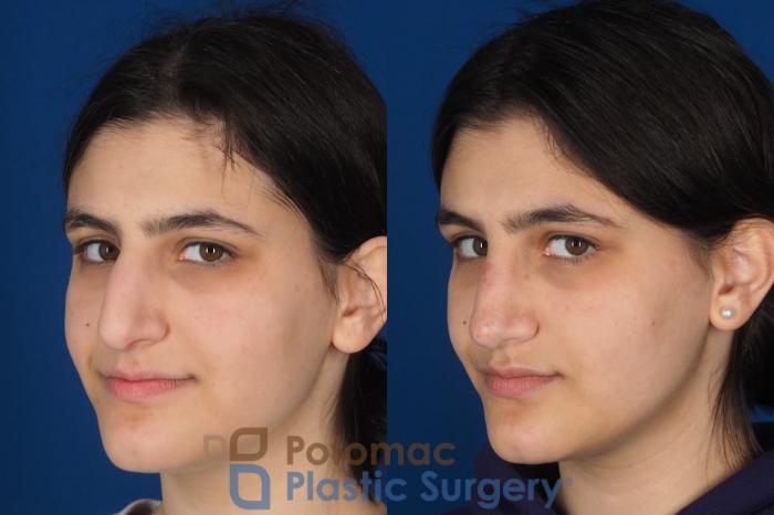 Before & After Rhinoplasty - Cosmetic Case 336 Left Oblique 2 View in Washington DC & Arlington , DC