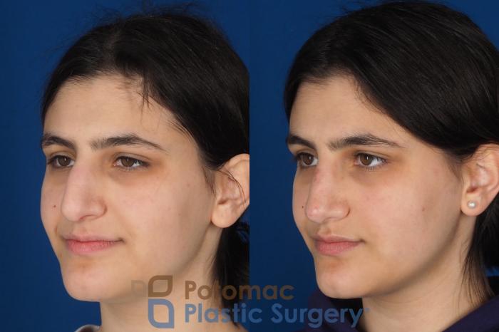 Before & After Rhinoplasty - Cosmetic Case 336 Left Oblique View in Washington DC & Arlington , DC