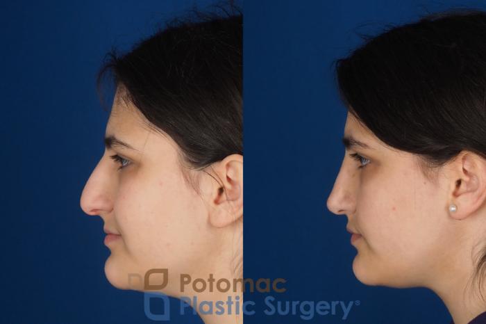 Before & After Rhinoplasty - Cosmetic Case 336 Left Side View in Washington DC & Arlington , DC