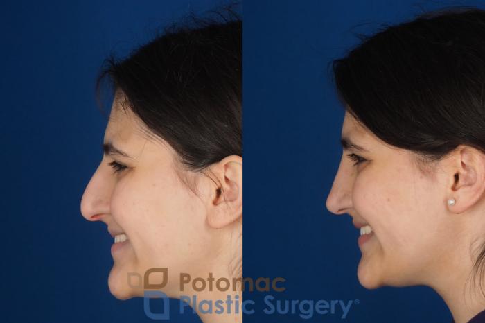 Before & After Rhinoplasty - Cosmetic Case 336 Left - Smiling View in Washington DC & Arlington , DC