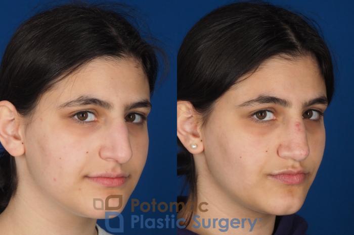 Before & After Rhinoplasty - Cosmetic Case 336 Right Oblique 2 View in Washington DC & Arlington , DC