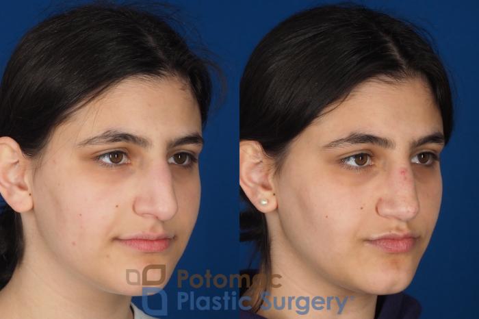 Before & After Rhinoplasty - Cosmetic Case 336 Right Oblique View in Washington DC & Arlington , DC