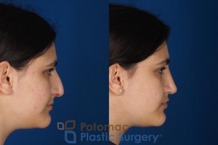 Before & After Rhinoplasty - Cosmetic Case 336 Right Side View in Washington DC & Arlington , DC