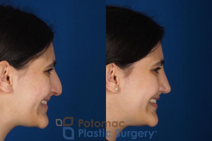 Before & After Rhinoplasty - Cosmetic Case 336 Right - Smiling View in Washington DC & Arlington , DC