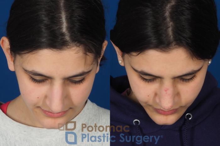 Before & After Rhinoplasty - Cosmetic Case 336 Top View in Washington DC & Arlington , DC