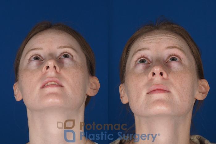 Before & After Rhinoplasty - Cosmetic Case 337 Bottom View in Washington DC & Arlington , DC