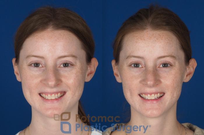 Before & After Rhinoplasty - Cosmetic Case 337 Front - Smiling View in Washington DC & Arlington , DC