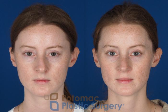 Before & After Rhinoplasty - Cosmetic Case 337 Front View in Washington DC & Arlington , DC