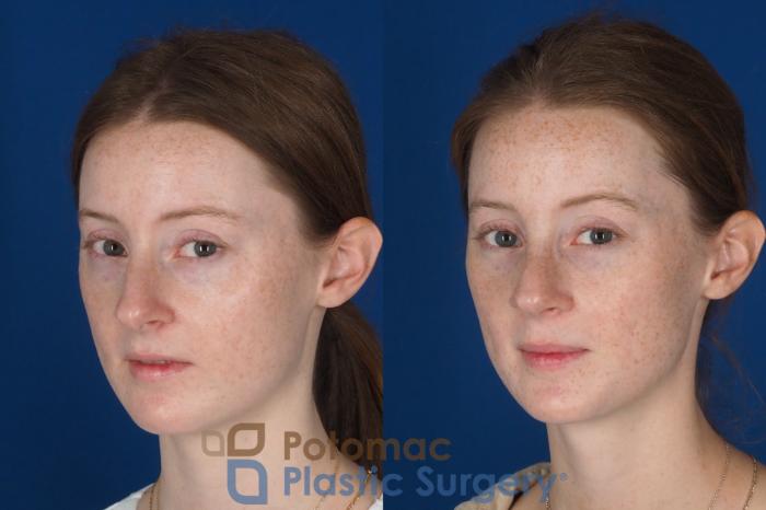 Before & After Rhinoplasty - Cosmetic Case 337 Left Oblique 2 View in Washington DC & Arlington , DC