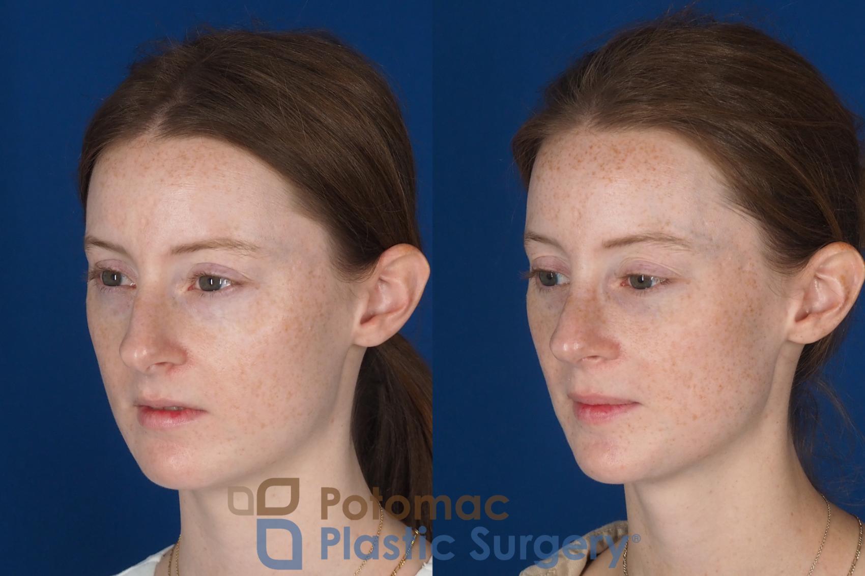 Before & After Rhinoplasty - Cosmetic Case 337 Left Oblique View in Washington DC & Arlington , DC