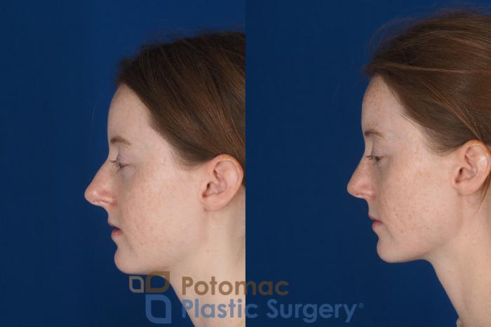 Before & After Rhinoplasty - Cosmetic Case 337 Left Side View in Washington DC & Arlington , DC