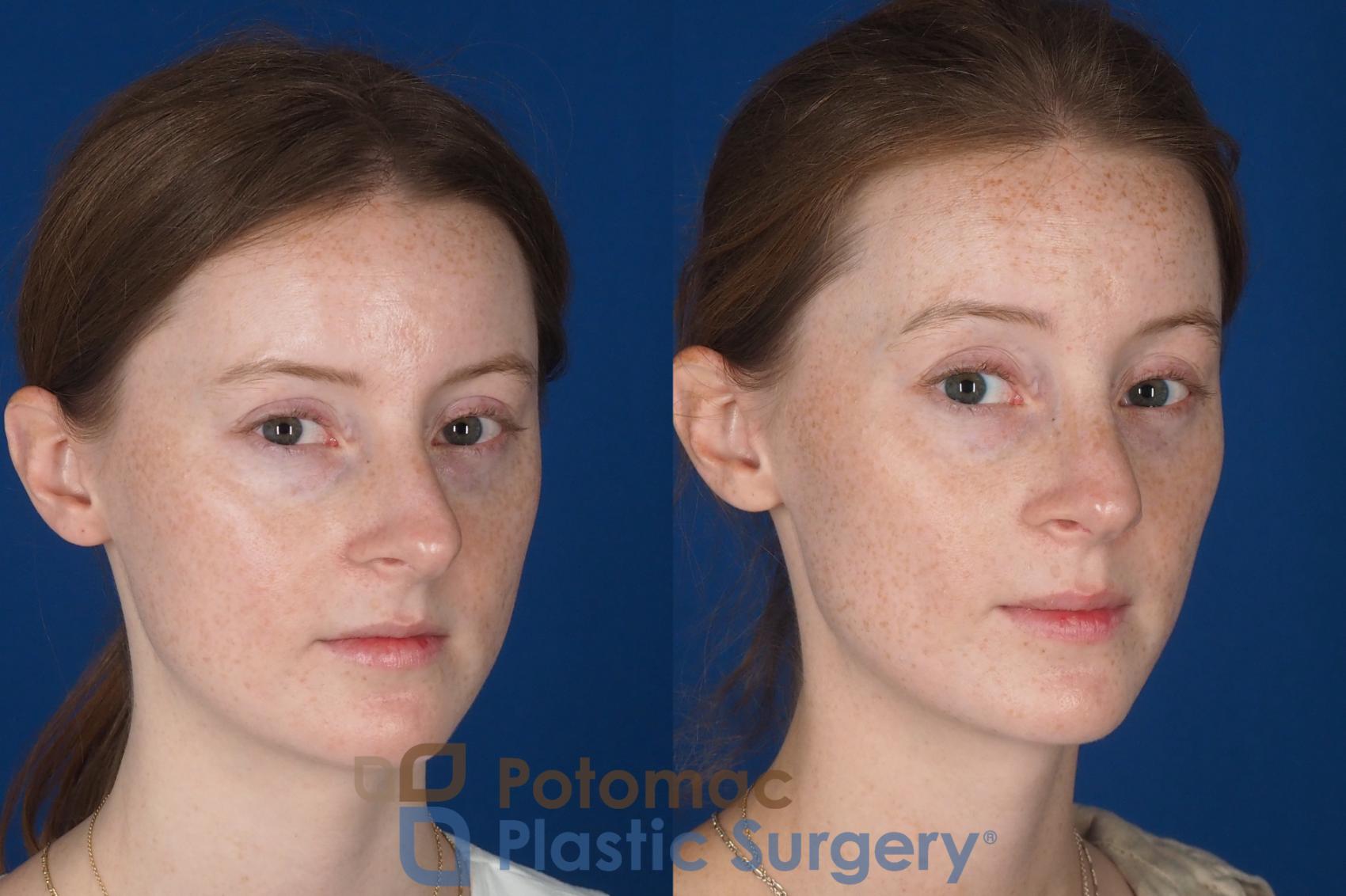Before & After Rhinoplasty - Cosmetic Case 337 Right Oblique 2 View in Washington DC & Arlington , DC