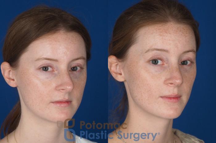 Before & After Rhinoplasty - Cosmetic Case 337 Right Oblique 2 View in Washington DC & Arlington , DC