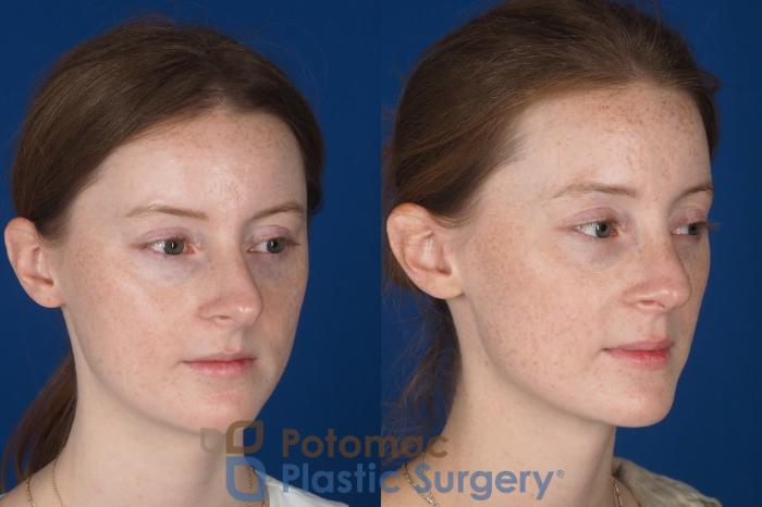 Before & After Rhinoplasty - Cosmetic Case 337 Right Oblique View in Washington DC & Arlington , DC