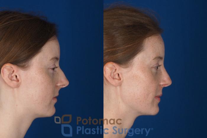 Before & After Rhinoplasty - Cosmetic Case 337 Right Side View in Washington DC & Arlington , DC