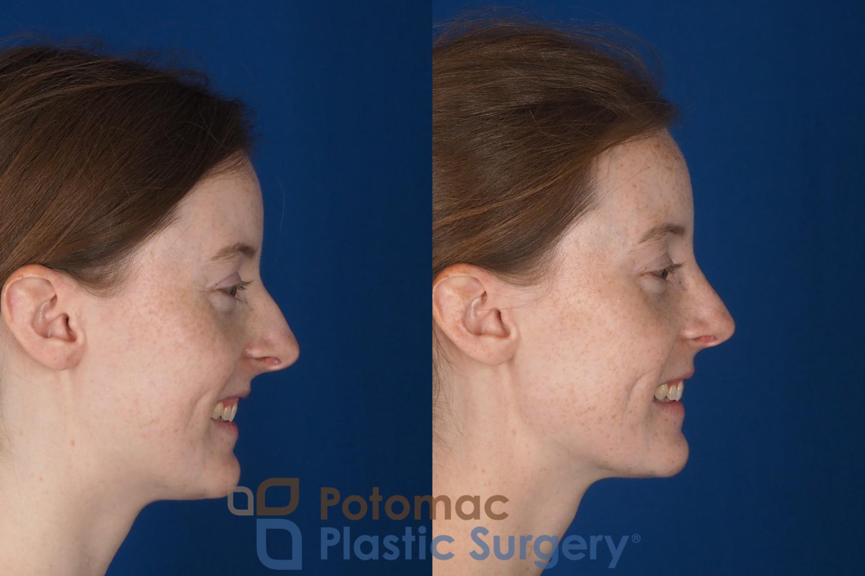 Before & After Rhinoplasty - Cosmetic Case 337 Right - Smiling View in Washington DC & Arlington , DC