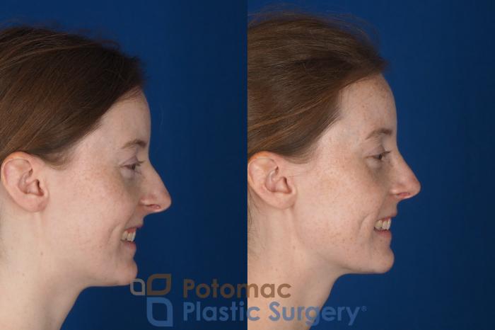 Before & After Rhinoplasty - Cosmetic Case 337 Right - Smiling View in Washington DC & Arlington , DC