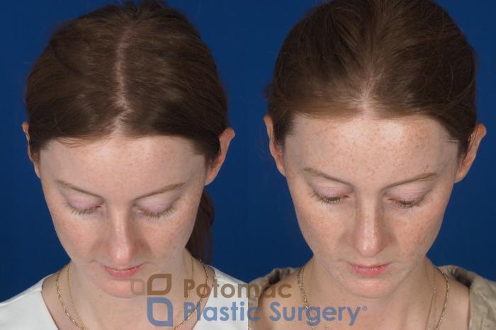 Before & After Rhinoplasty - Cosmetic Case 337 Top View in Washington DC & Arlington , DC