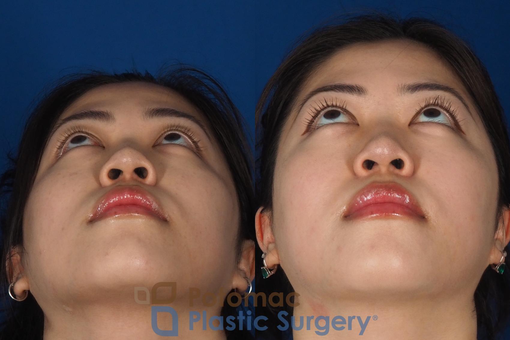 Before & After Asian Eyelid Surgery Case 342 Bottom View in Washington DC & Arlington , DC