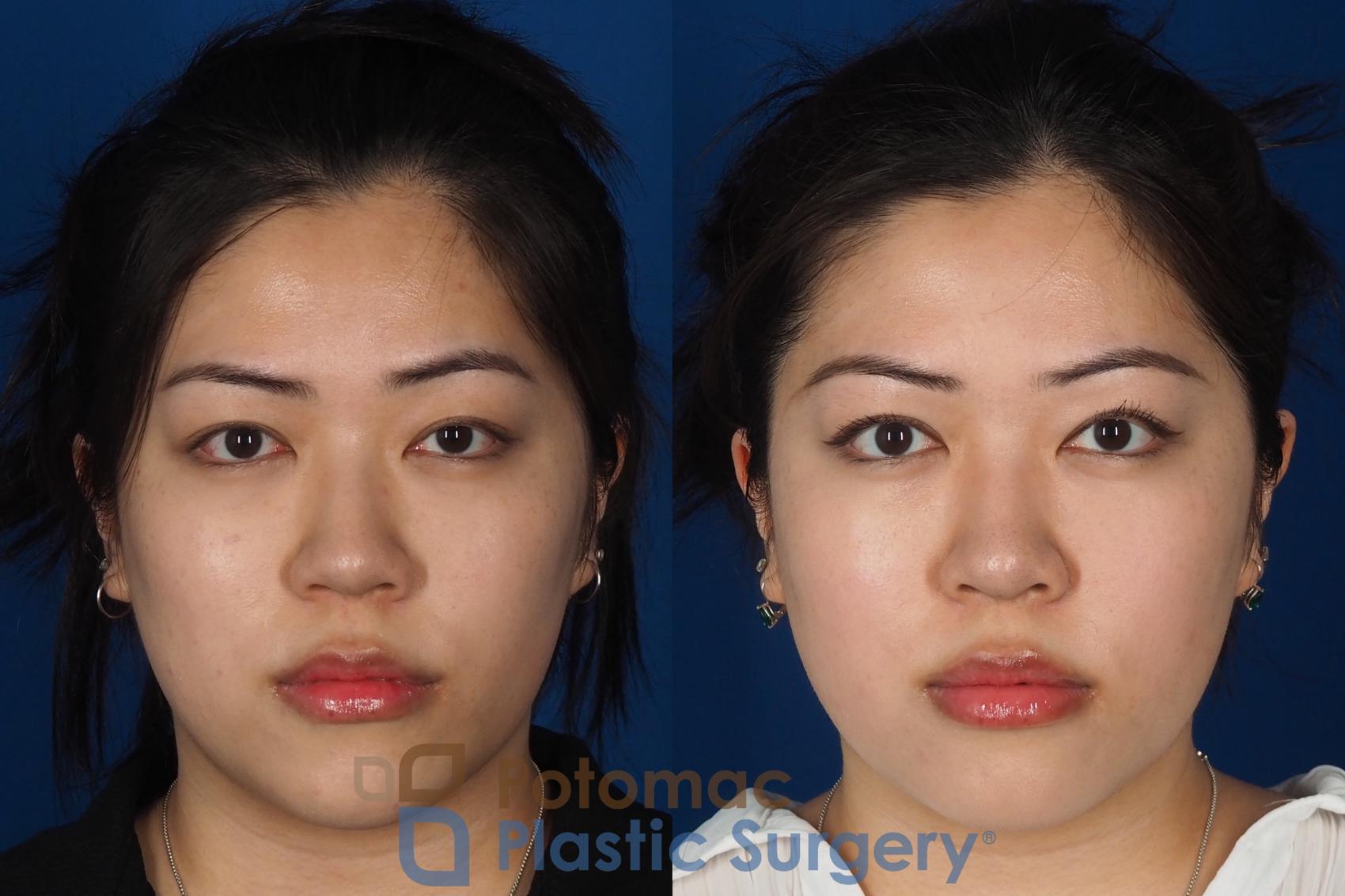 Before & After Asian Eyelid Surgery Case 342 Front View in Washington DC & Arlington , DC