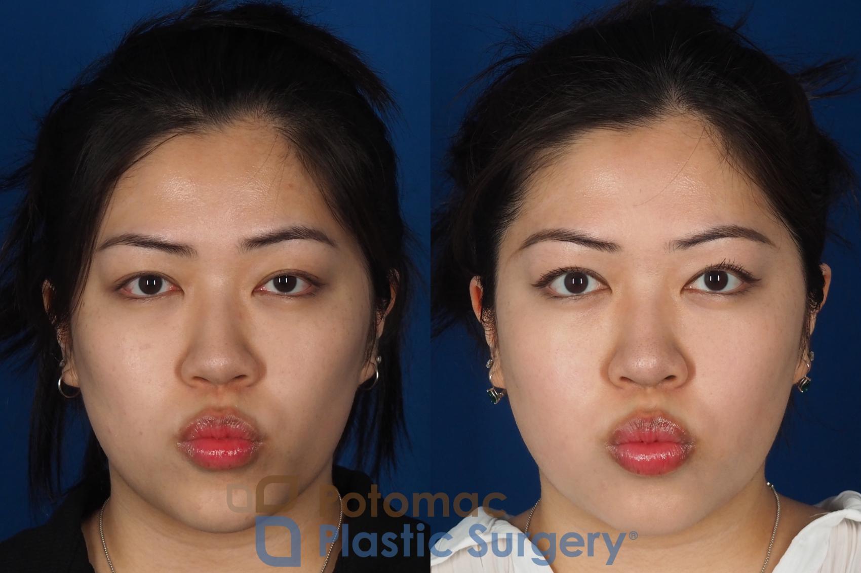 Before & After Asian Eyelid Surgery Case 342 Front - Puckering View in Washington DC & Arlington , DC