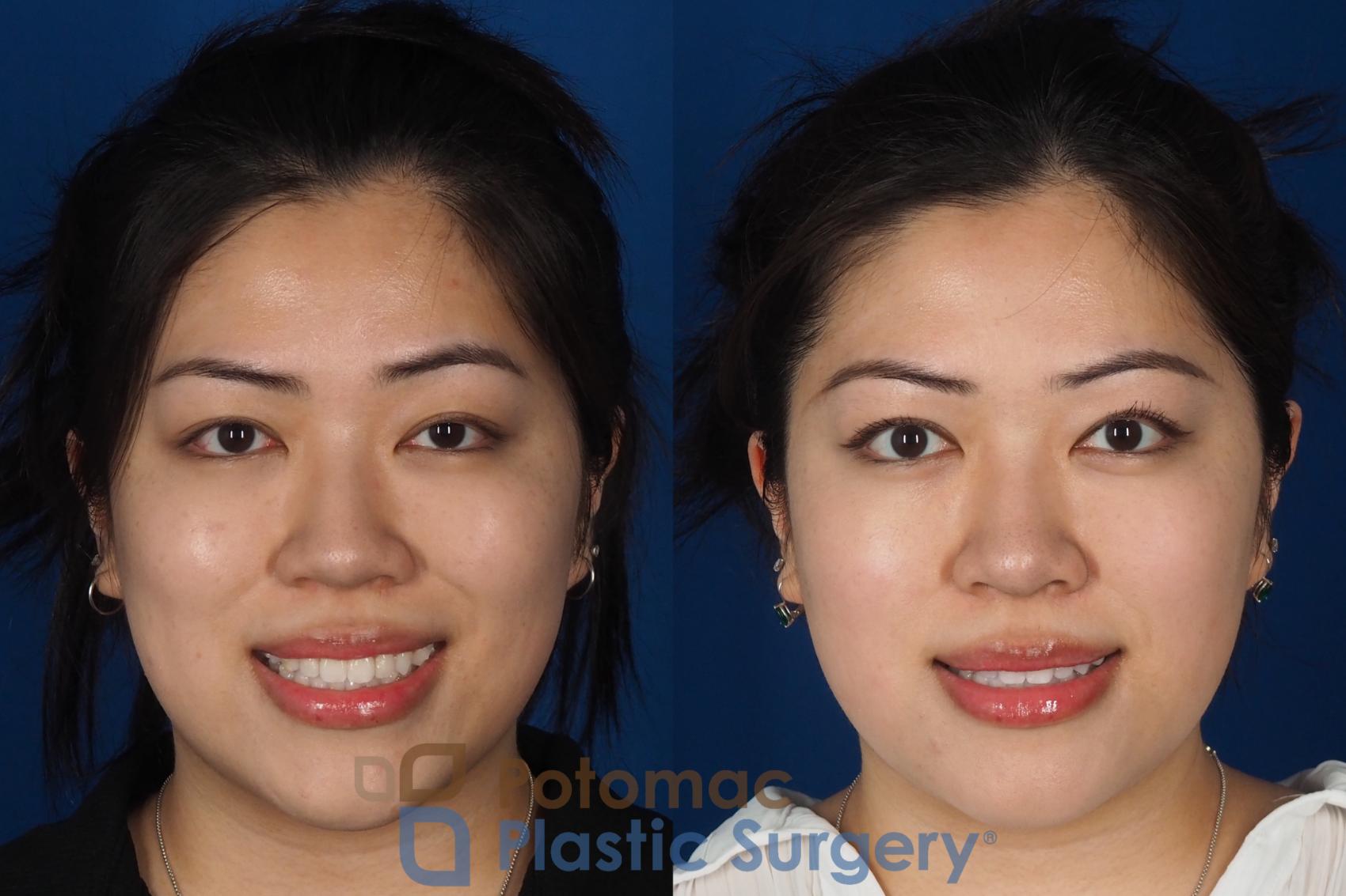 Before & After Asian Eyelid Surgery Case 342 Front - Smiling View in Washington DC & Arlington , DC