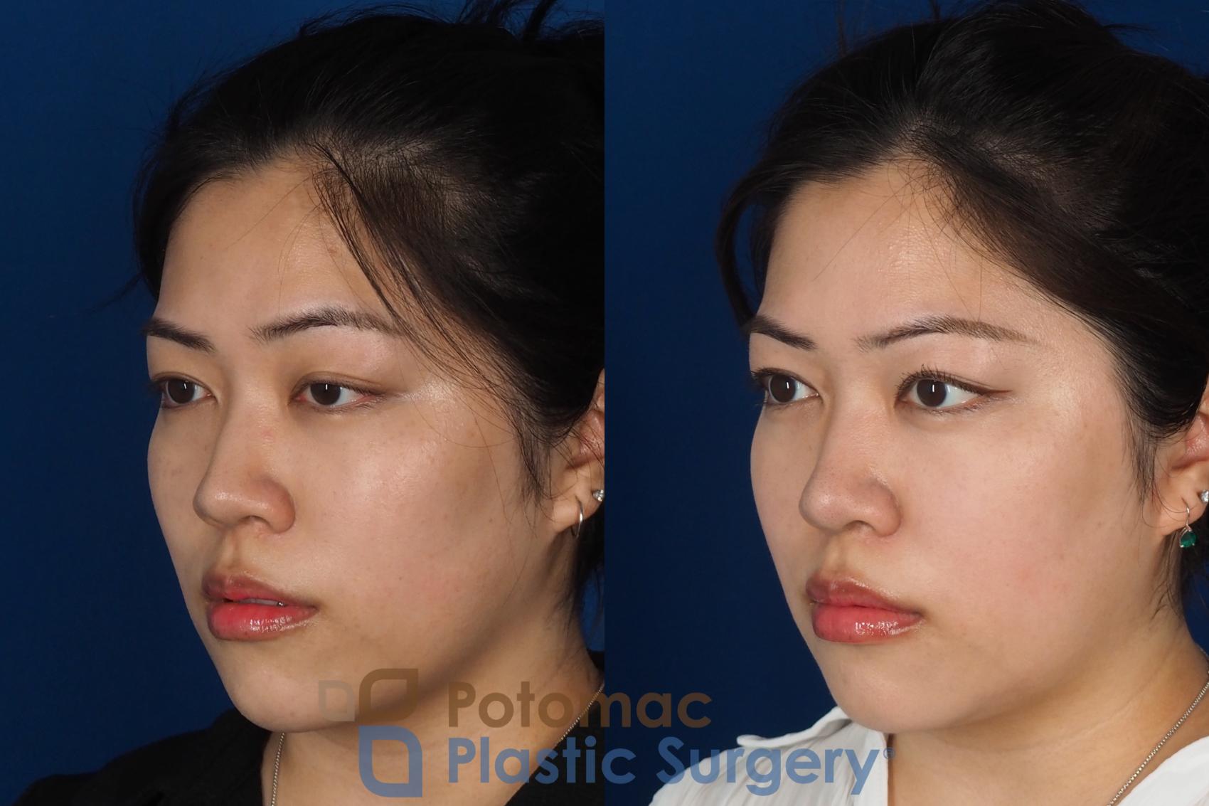 Before & After Asian Eyelid Surgery Case 342 Left Oblique View in Washington DC & Arlington , DC