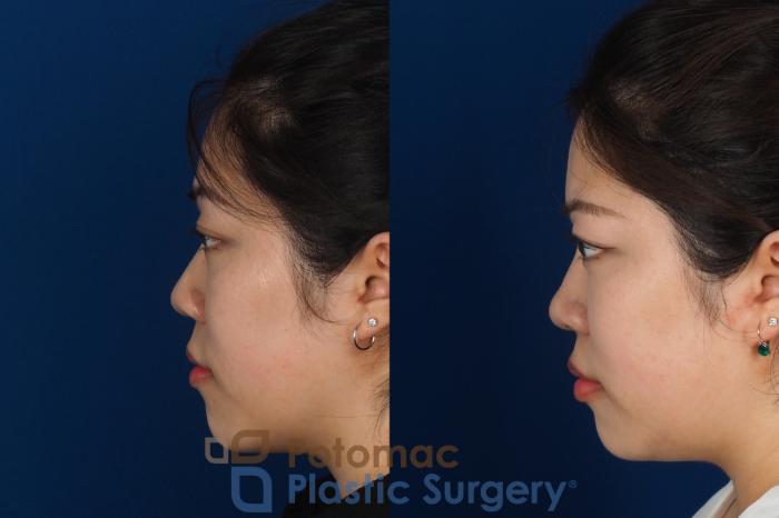 Before & After Asian Eyelid Surgery Case 342 Left Side View in Washington DC & Arlington , DC