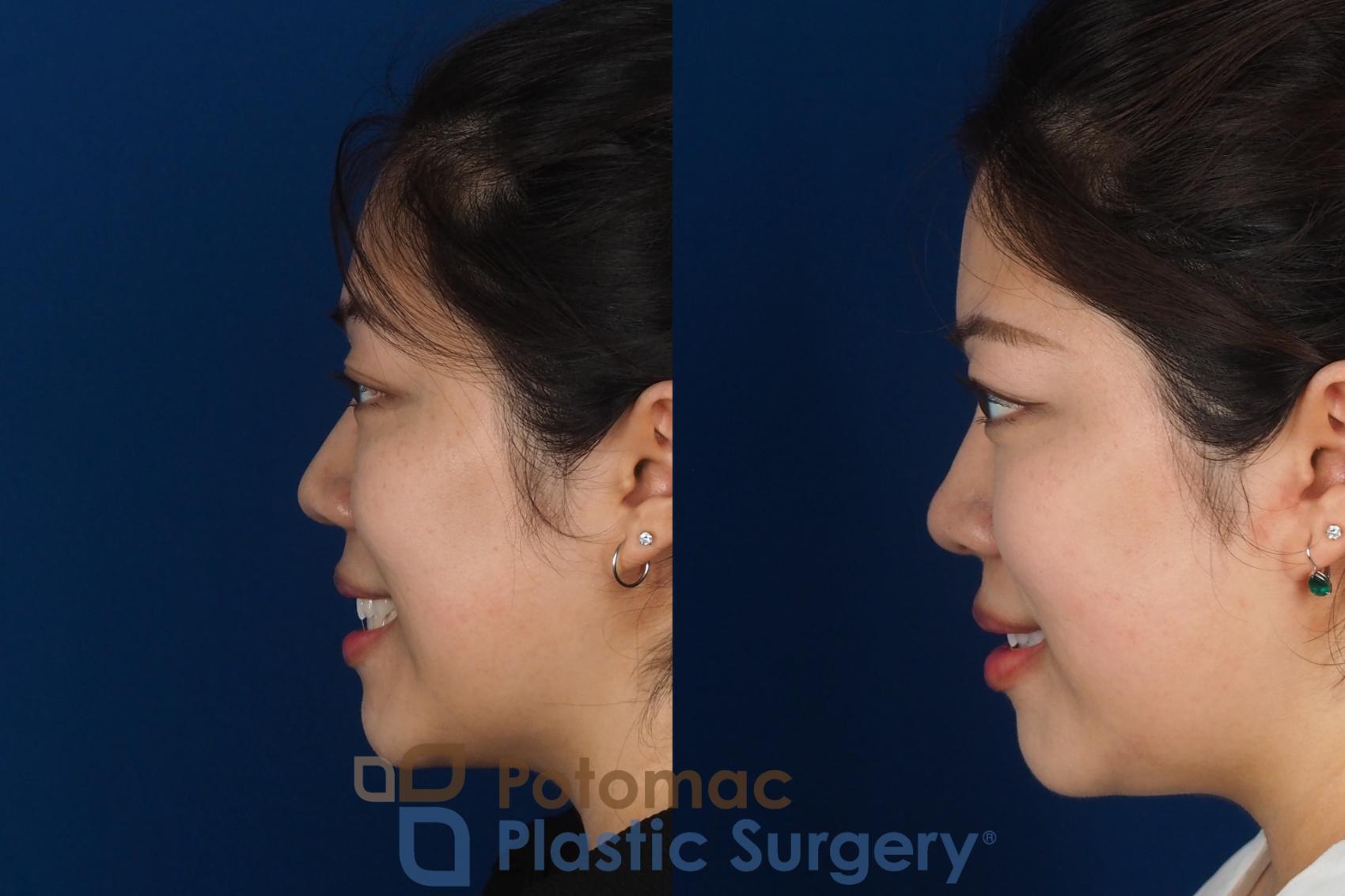 Before & After Asian Eyelid Surgery Case 342 Left - Smiling View in Washington DC & Arlington , DC