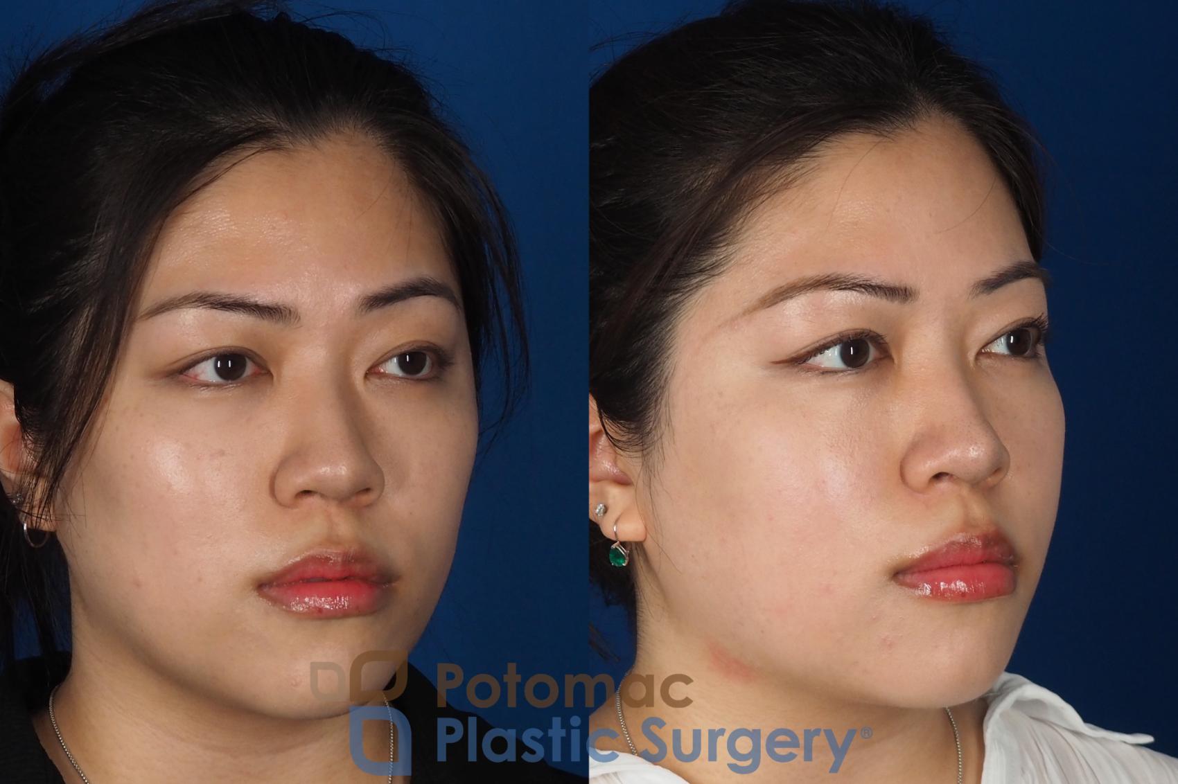 Before & After Asian Eyelid Surgery Case 342 Right Oblique View in Washington DC & Arlington , DC