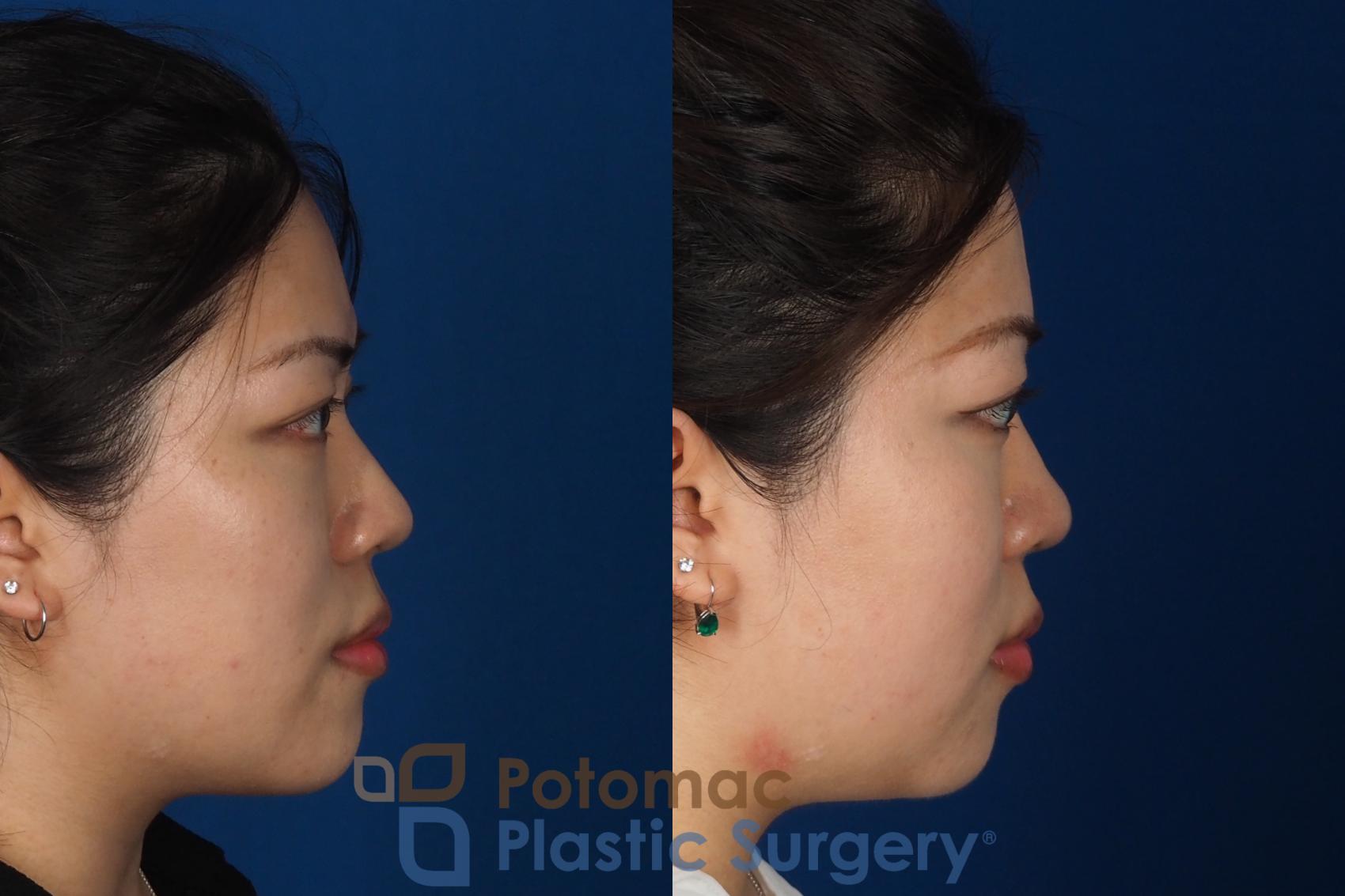 Before & After Asian Eyelid Surgery Case 342 Right Side View in Washington DC & Arlington , DC