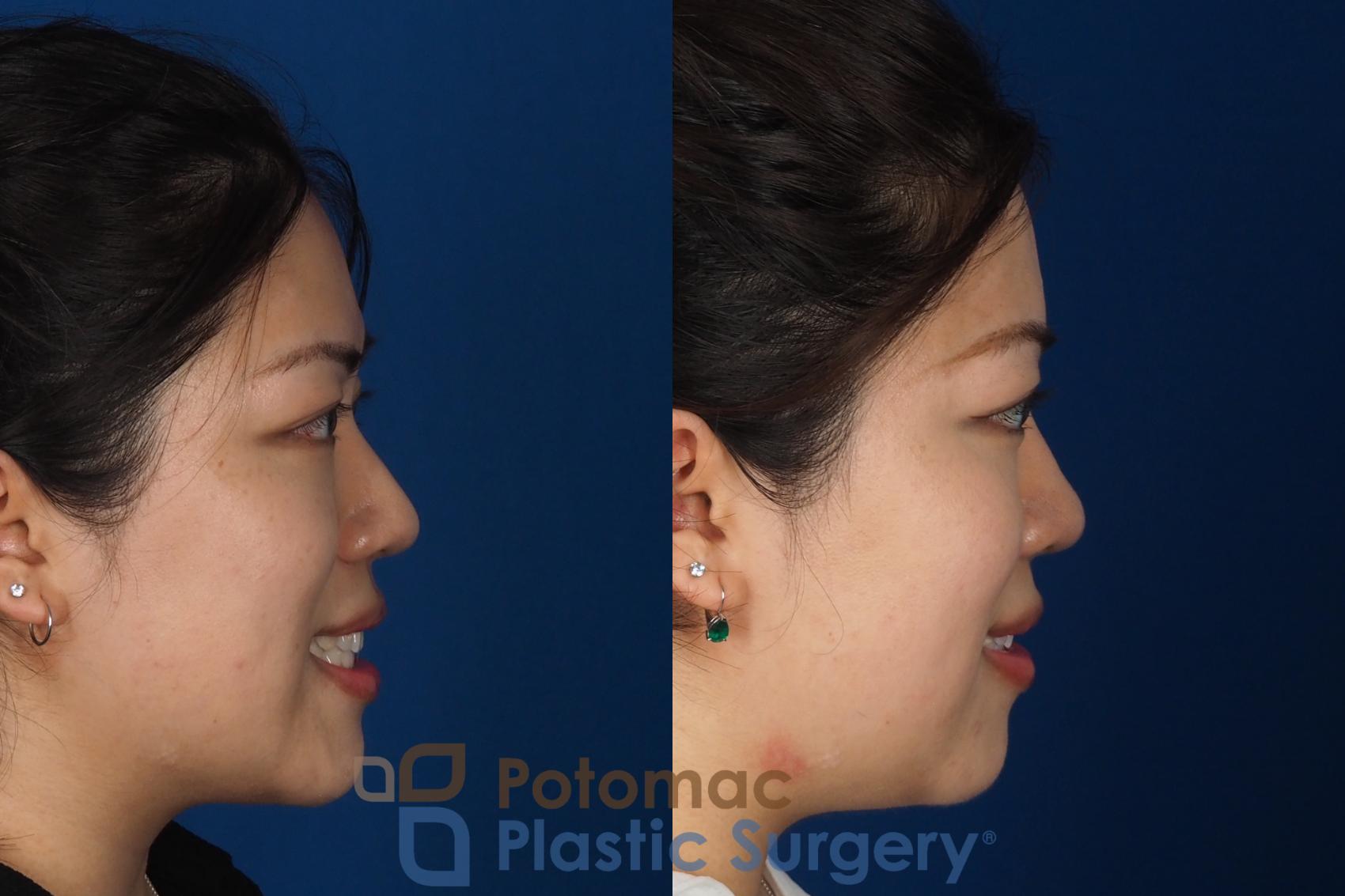 Before & After Asian Eyelid Surgery Case 342 Right - Smiling View in Washington DC & Arlington , DC