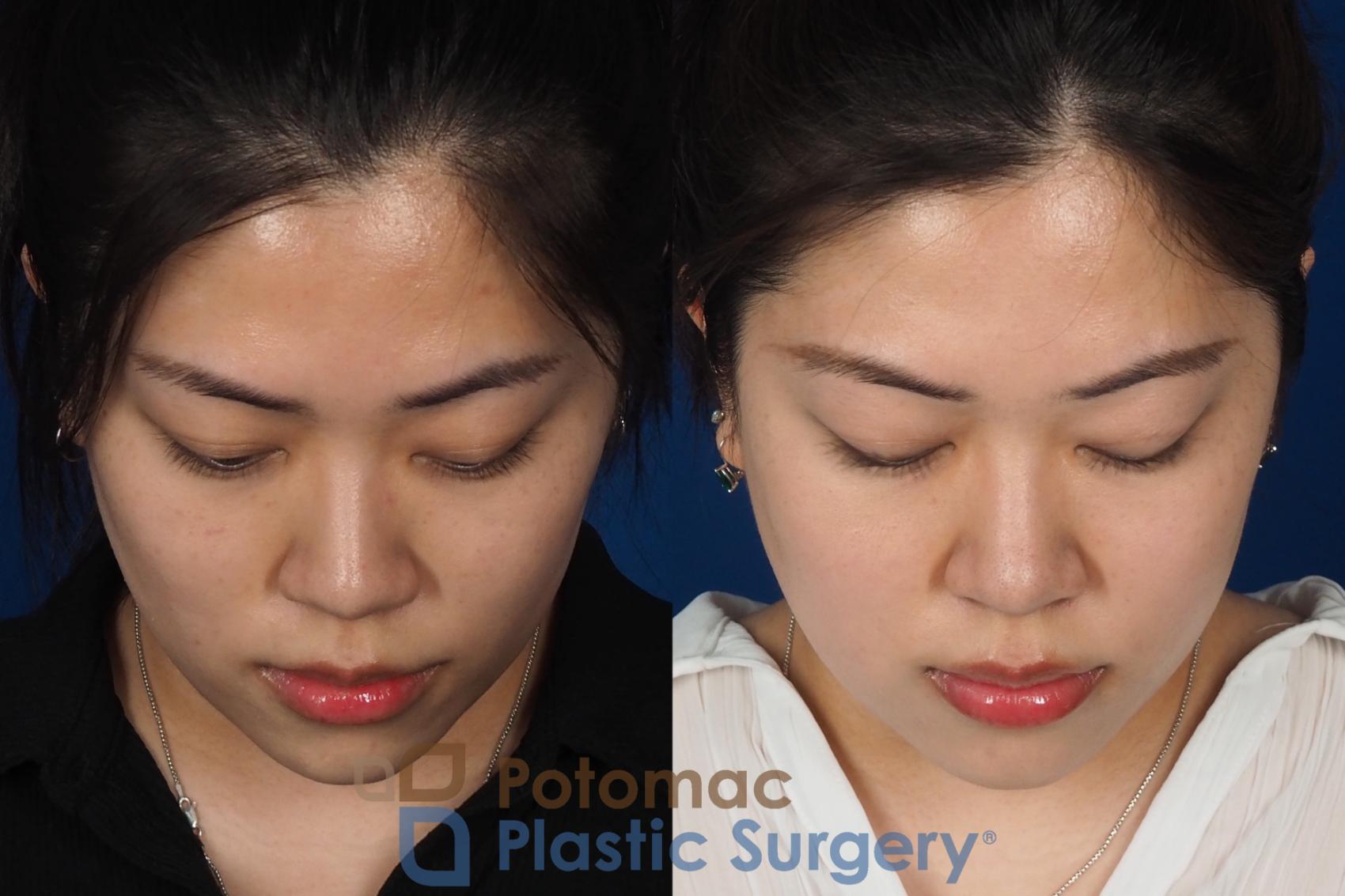 Before & After Asian Eyelid Surgery Case 342 Top View in Washington DC & Arlington , DC