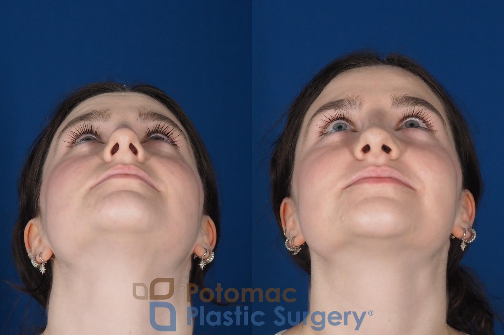 Before & After Rhinoplasty - Cosmetic Case 345 Bottom View in Washington DC & Arlington , DC