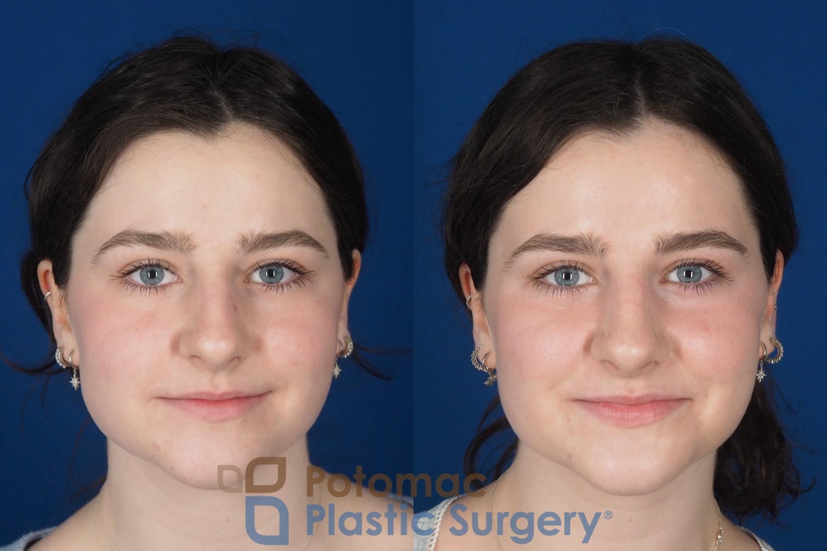 Before & After Rhinoplasty - Cosmetic Case 345 Front View in Washington DC & Arlington , DC
