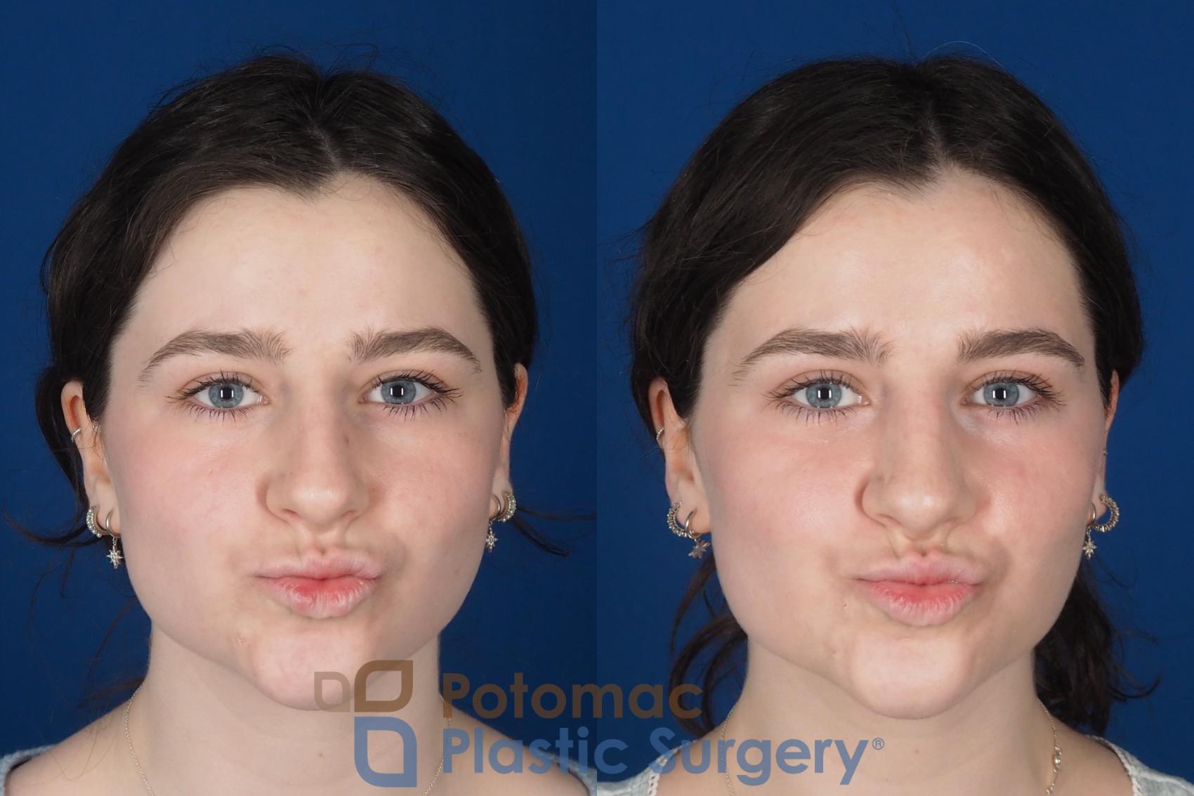 Before & After Rhinoplasty - Cosmetic Case 345 Front - Puckering View in Washington DC & Arlington , DC
