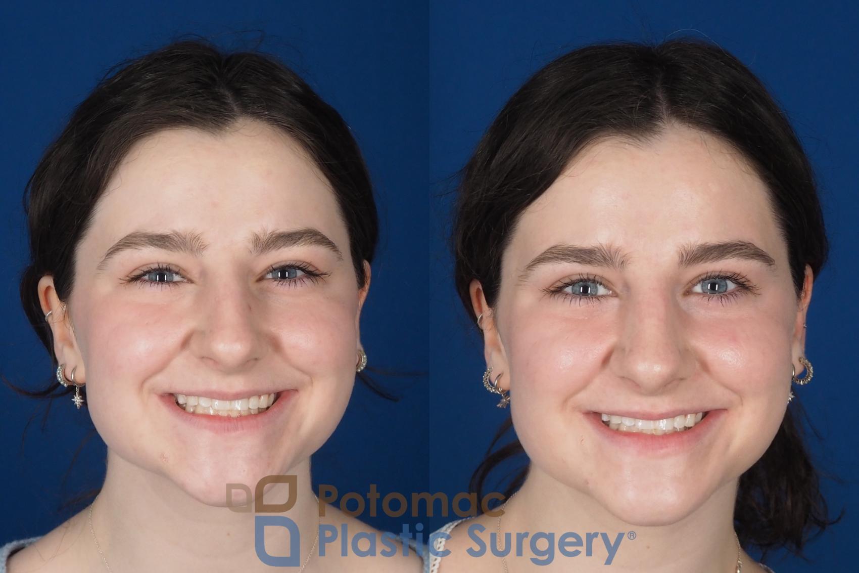 Before & After Rhinoplasty - Cosmetic Case 345 Front - Smiling View in Washington DC & Arlington , DC