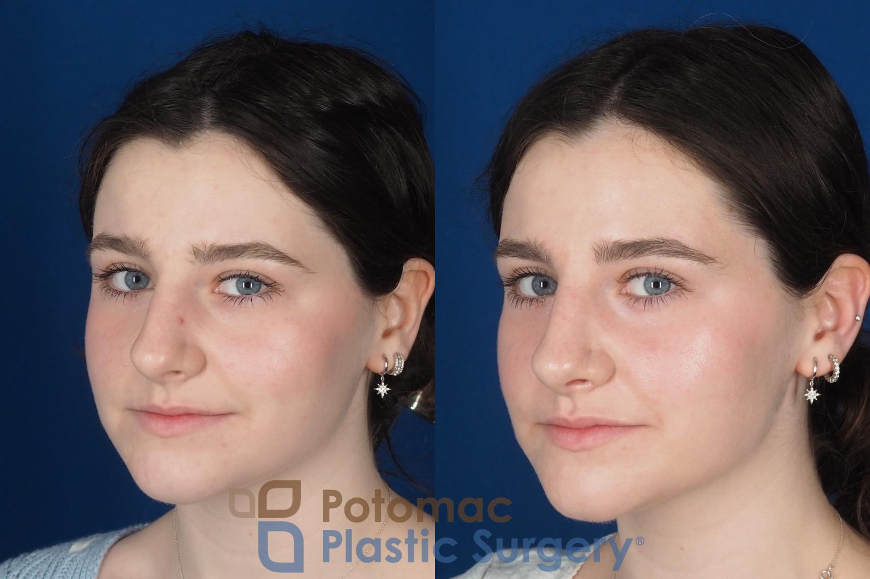 Before & After Rhinoplasty - Cosmetic Case 345 Left Oblique 2 View in Washington DC & Arlington , DC