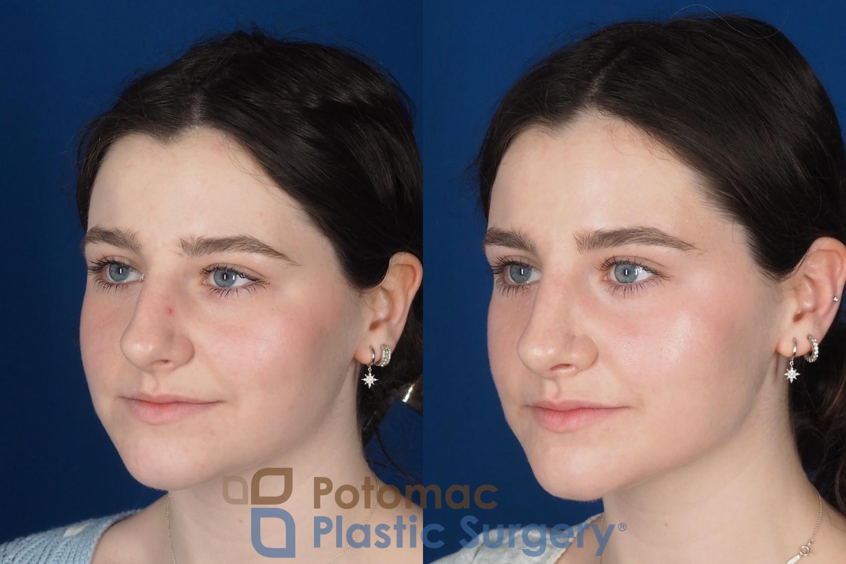 Before & After Rhinoplasty - Cosmetic Case 345 Left Oblique View in Washington DC & Arlington , DC