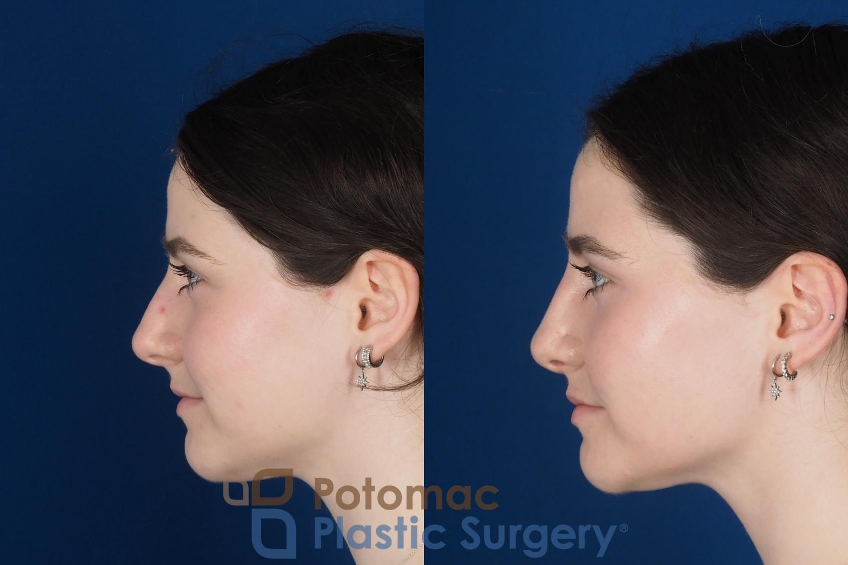 Before & After Rhinoplasty - Cosmetic Case 345 Left Side View in Washington DC & Arlington , DC